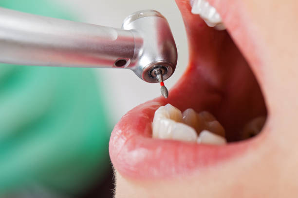 Best Emergency Treatment for Toothache in Williston, SC